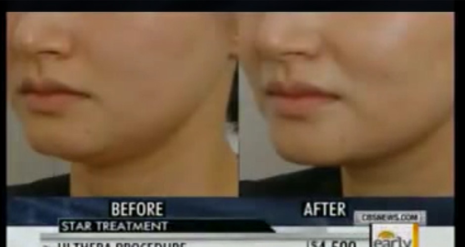 Get to know about non-surgical face lift with Ulthera technology.