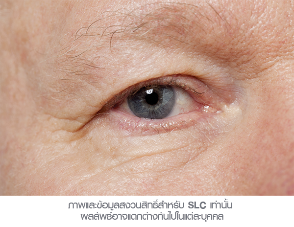 Endoscopic Brow Lift 