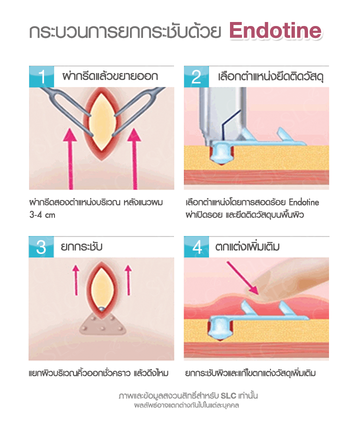 ยกคิ้ว Endotine ขั้นตอนการเปิดแผล