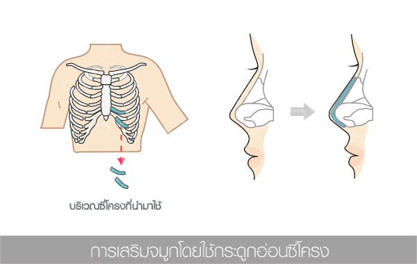 ศัลยกรรมเสริมจมูกสวยปลายพุ่ง ปลายหยดน้ำ