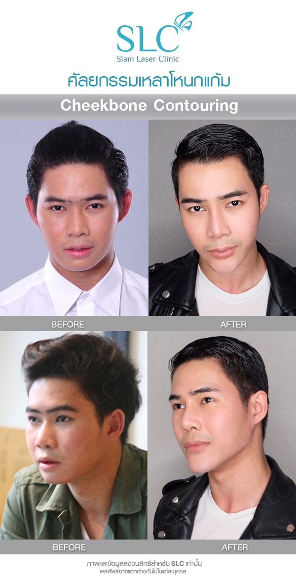 ฟลุค Makeover by SLC เหลาโหนกแก้ม