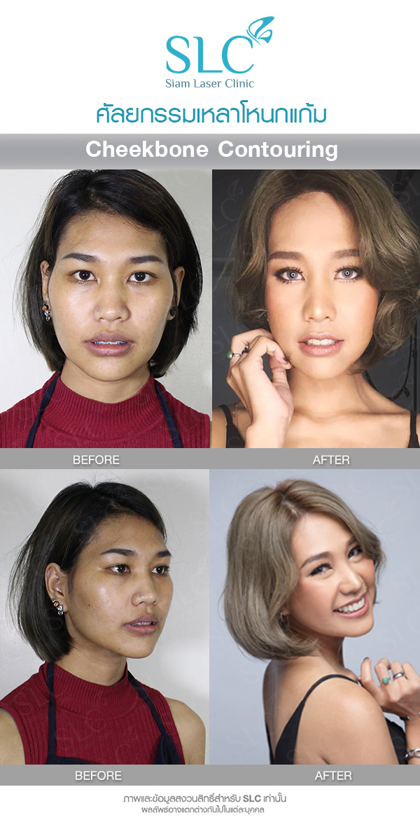 ตาตั้น  Makeover by SLC เหลาโหนกแก้ม