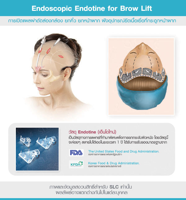 Endoscopic Endotine for Brow Lift 