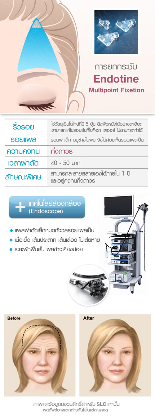 เม้าส์ นิกกี้ เสาวลักษณ์ จันทพันธ์  Suegery ศัลยกรรม  ผ่าตัดส่องหล้อง ยกคิ้ว ยกหน้าผาก 