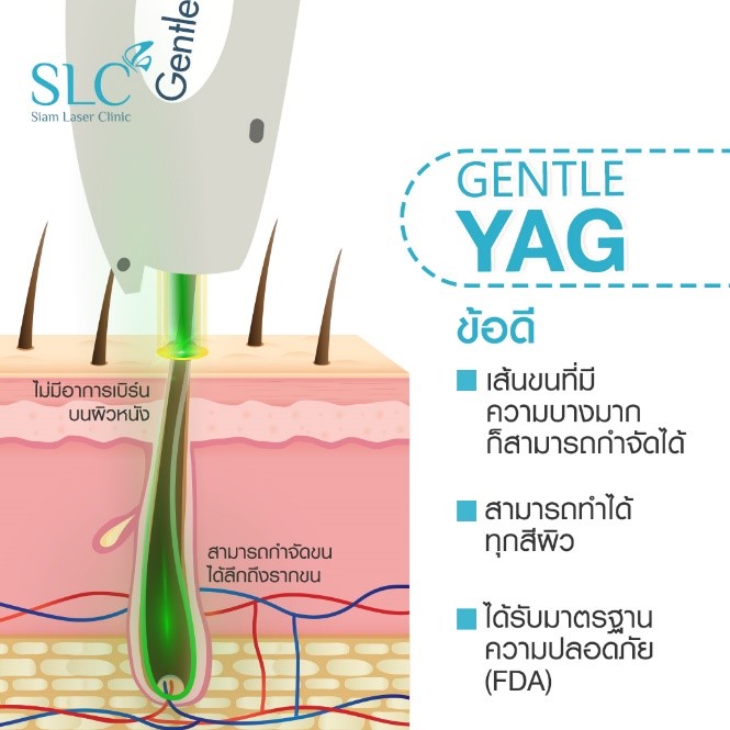 ทำไมต้องเลเซอร์กำจัดขนด้วย Gentle YAG Laser