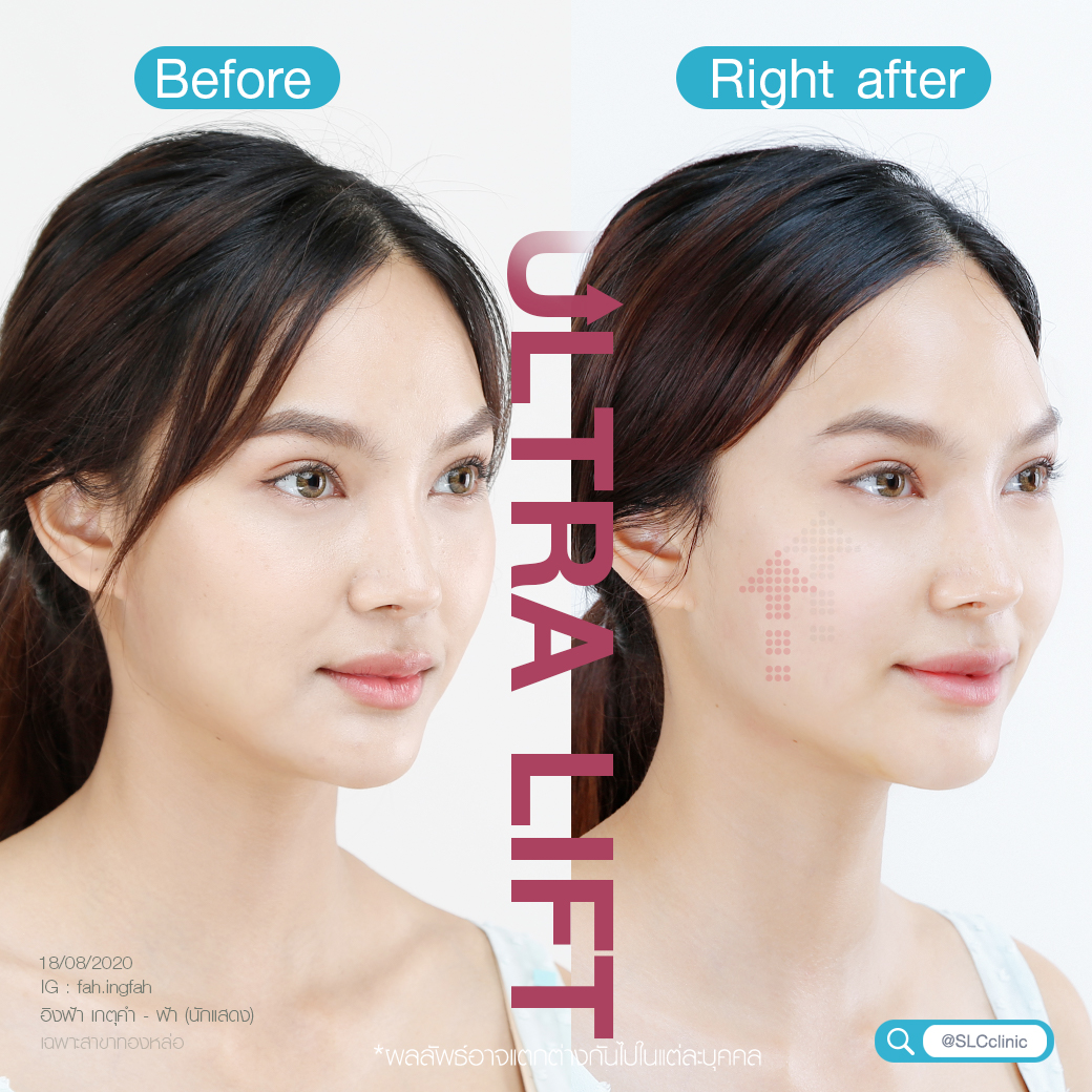 ยกกระชับ Ultralift