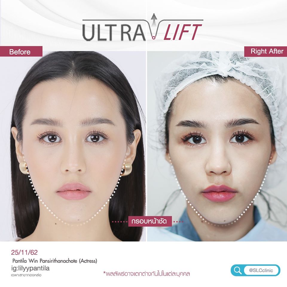 ยกกระชับ Ultralift