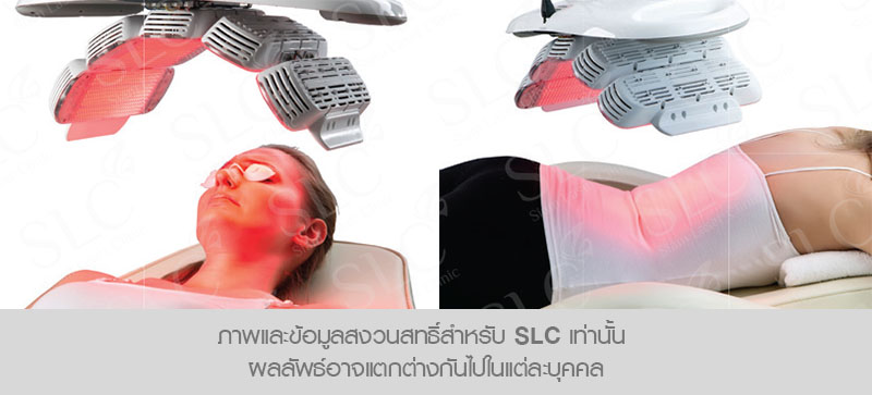 เลเซอร์ SLC