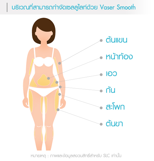 บริเวณที่สามารถกำจัดเซลลูไลท์ vaser smooth