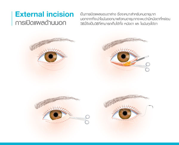 ผ่าตัดถุงใต้ตา แผลนอก