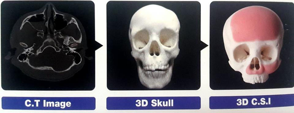 เสริมหน้าผาก x ray