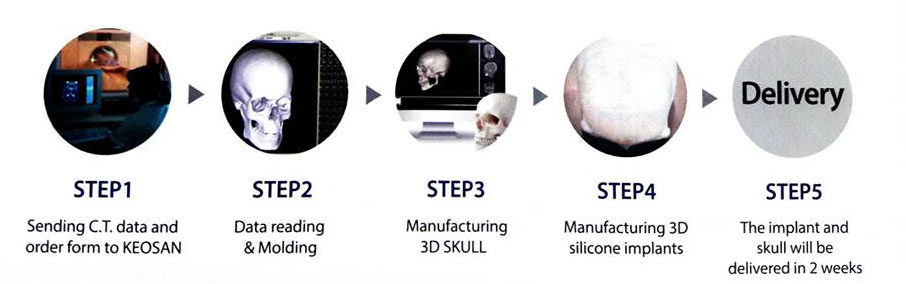 forehead augmentation process