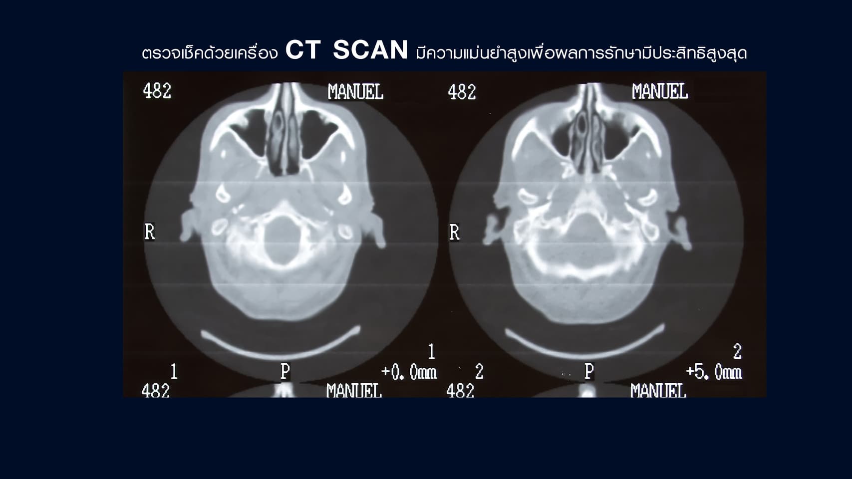 CT Scan เสริมหน้าผาก
