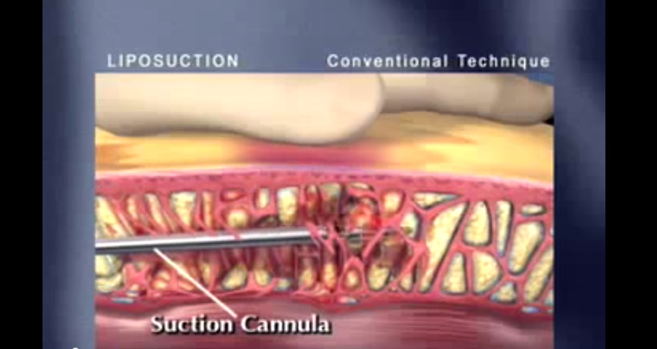 Get to know about fat elimination with Vaser Lipo Selection.