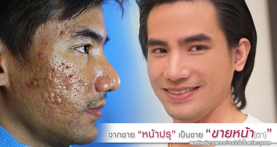 จาก ''ชายหน้าปรุ''  เป็น  ''ชายขายหน้า (ตา)''