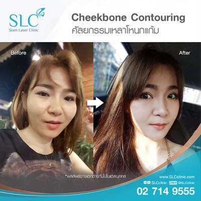 SLC Clinic - เหลาโหนกแก้ม 01