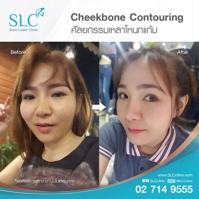 SLC Clinic - เหลาโหนกแก้ม 04