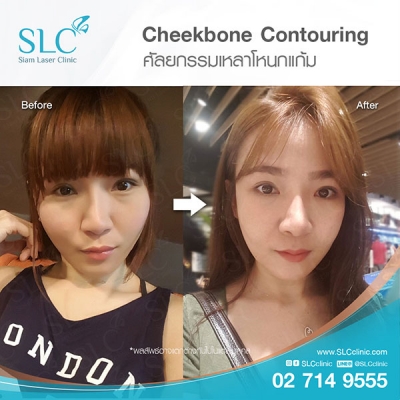 SLC Clinic - เหลาโหนกแก้ม 02