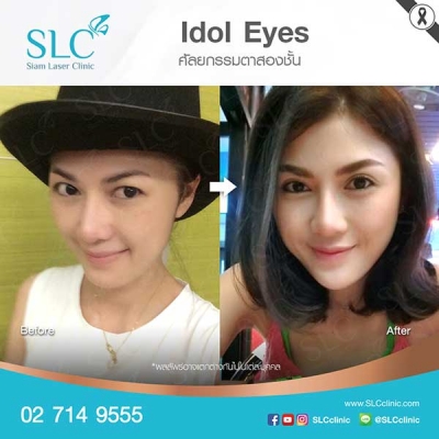 SLC Clinic - ตาสองชั้น ตาแบ๊ว ตาฝรั่ง ตาสายฝอ 03