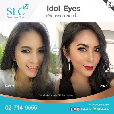 SLC Clinic - ตาสองชั้น ตาแบ๊ว ตาฝรั่ง ตาสายฝอ 05