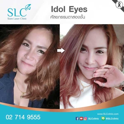 SLC Clinic - ตาสองชั้น ตาแบ๊ว ตาฝรั่ง ตาสายฝอ 08