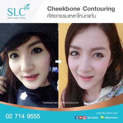 SLC Clinic - เหลาโหนกแก้ม 05