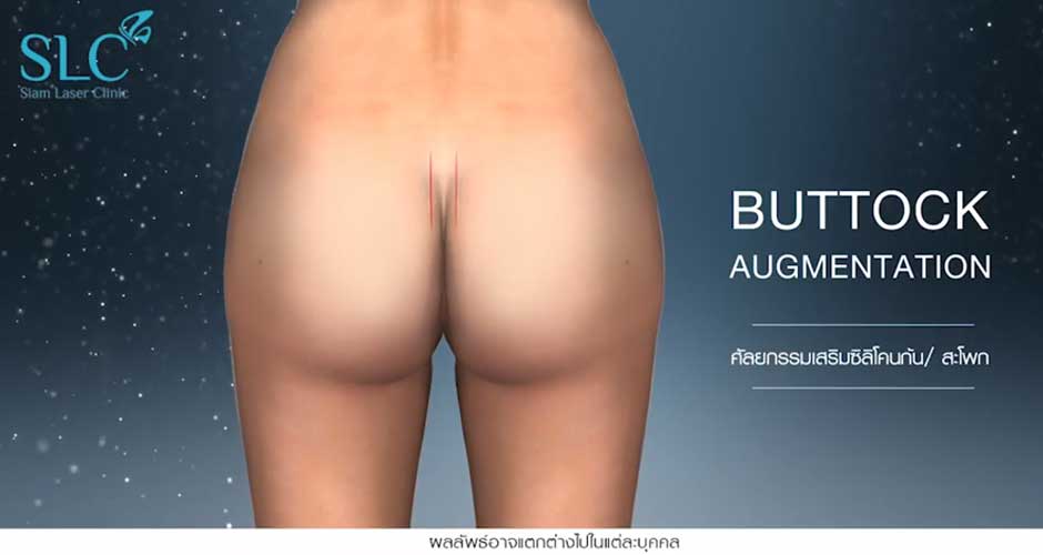 Buttock augmentation