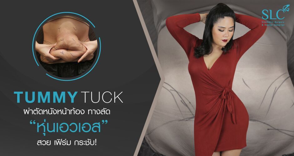 รีวิว “Tummy Tuck”  ผ่าตัดหนังหน้าท้อง ทางลัด “ หุ่นเอวเอส ” สวย เฟิร์ม กระชับ