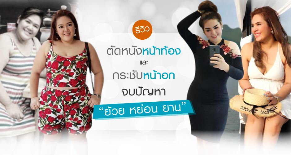 รีวิว ตัดหนังหน้าท้อง เเละ ยกกระชับหน้าอก   (Tummy Tuck & Breast Lifting) จบปัญหา 