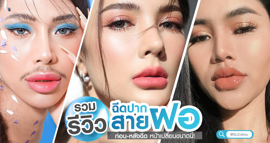 รวมรีวิว! ฉีดปากสายฝอ ก่อน-หลังฉีด หน้าเปลี่ยนขนาดนี้!