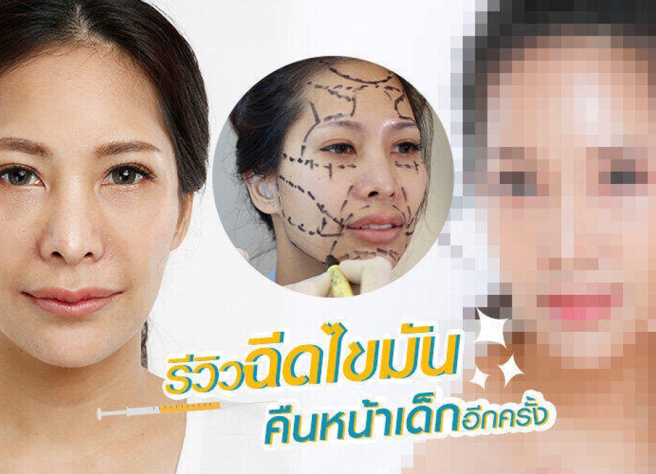 รีวิวฉีดไขมัน คืนหน้าเด็ก