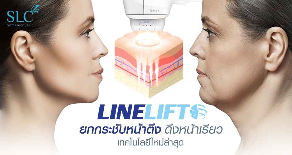 Linelift ยกผิวตึง ดึงผิวกระชับ โดยไม่ต้องผ่าตัด 