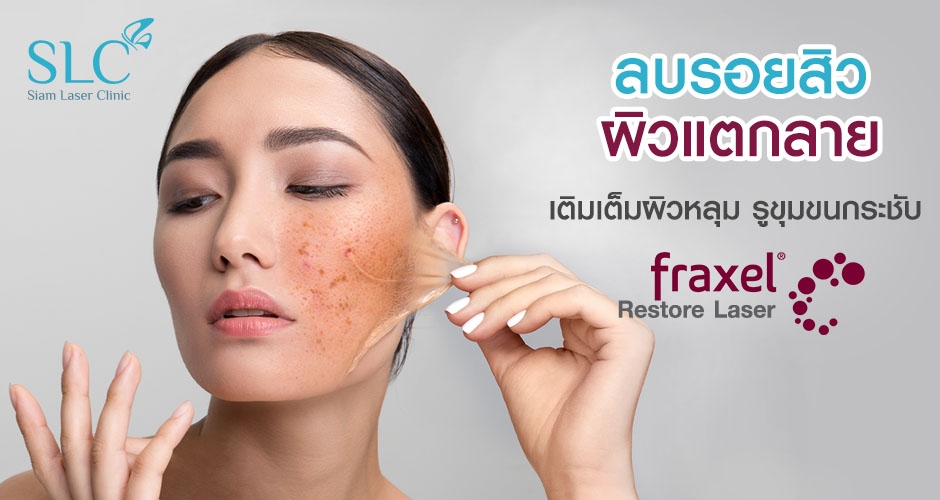 Fraxel Restore Laser ลบรอยสิว ผิวแตกลาย กระชับรูขุมขน ผิวเรียบเนียน