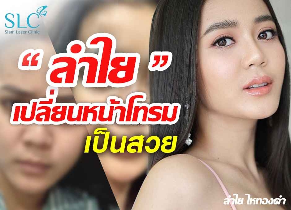 ลำไย ไหทองคำ ฉีดสารเติมเต็ม เปลี่ยนความโทรม เป็นสวย หน้าเด็กลงได้ ใน 1 ชม.