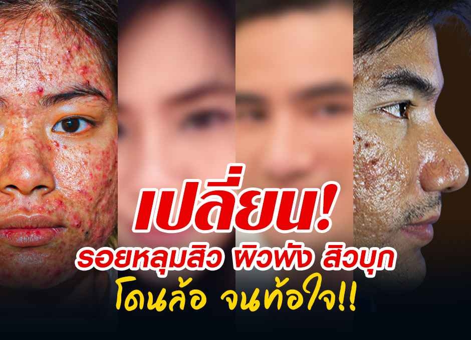 เปลี่ยนผิวใหม่ รอยหลุมสิว ผิวพัง สิวบุก โดนล้อ จนท้อใจ!! 