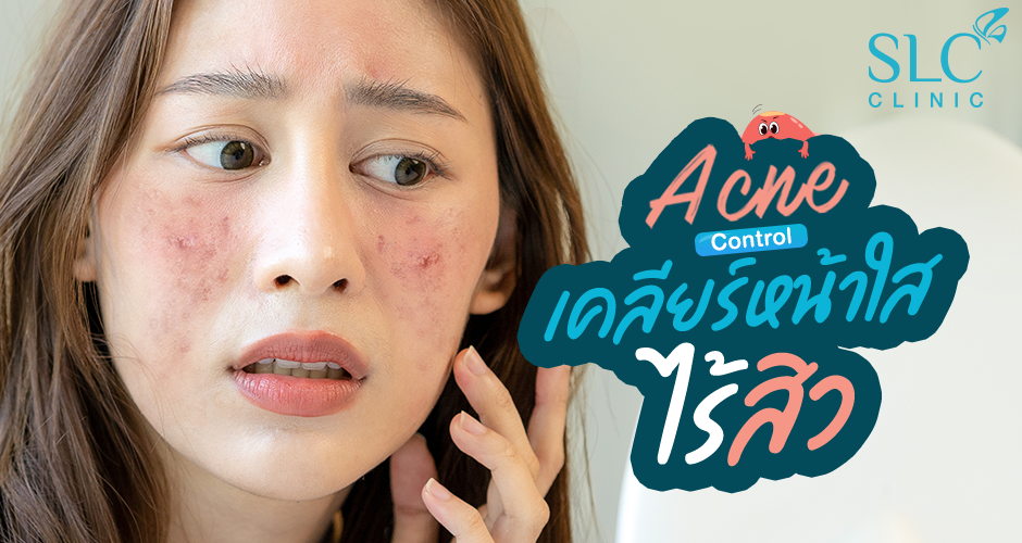 Acne Control เคลียร์ หน้าใส ไร้สิว