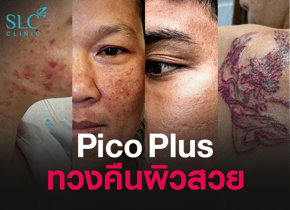 Pico Plus Laser ทวงคืนผิวสวย รักษาหลุมสิว รอยสิว ฝ้า รอยสัก ผิวไม่ตกสะเก็ด