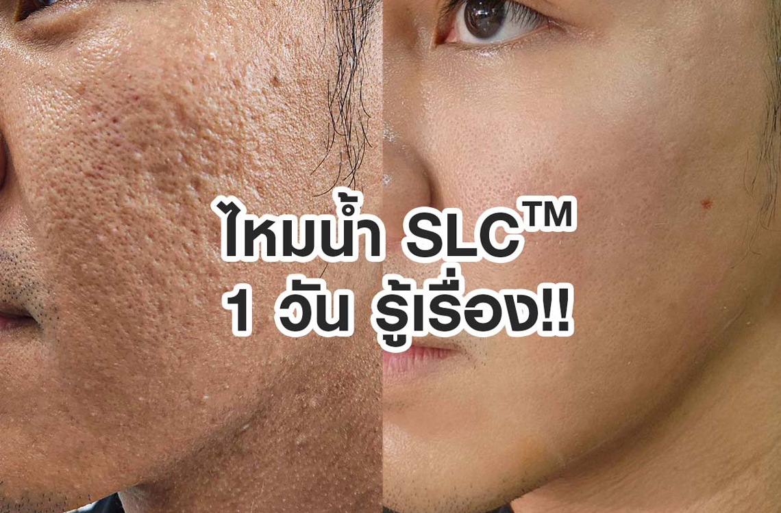 รีวิวไหมน้ำ Ultracol 100 SLC 1 วัน
