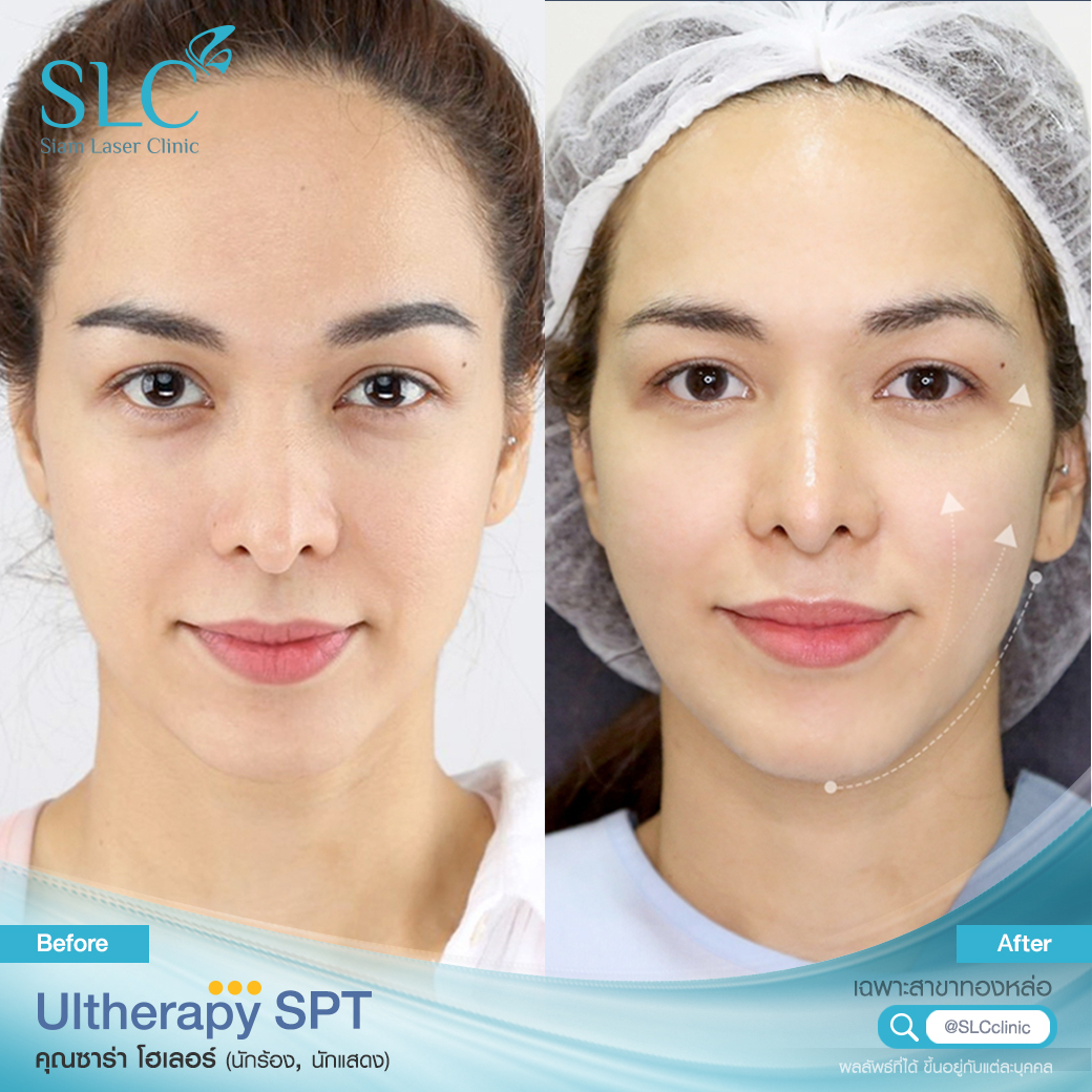 Ultherapy SPT ยกกระชับ