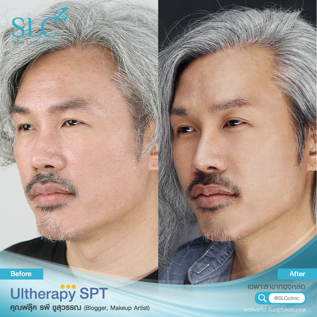 Ultherapy SPT ยกกระชับ