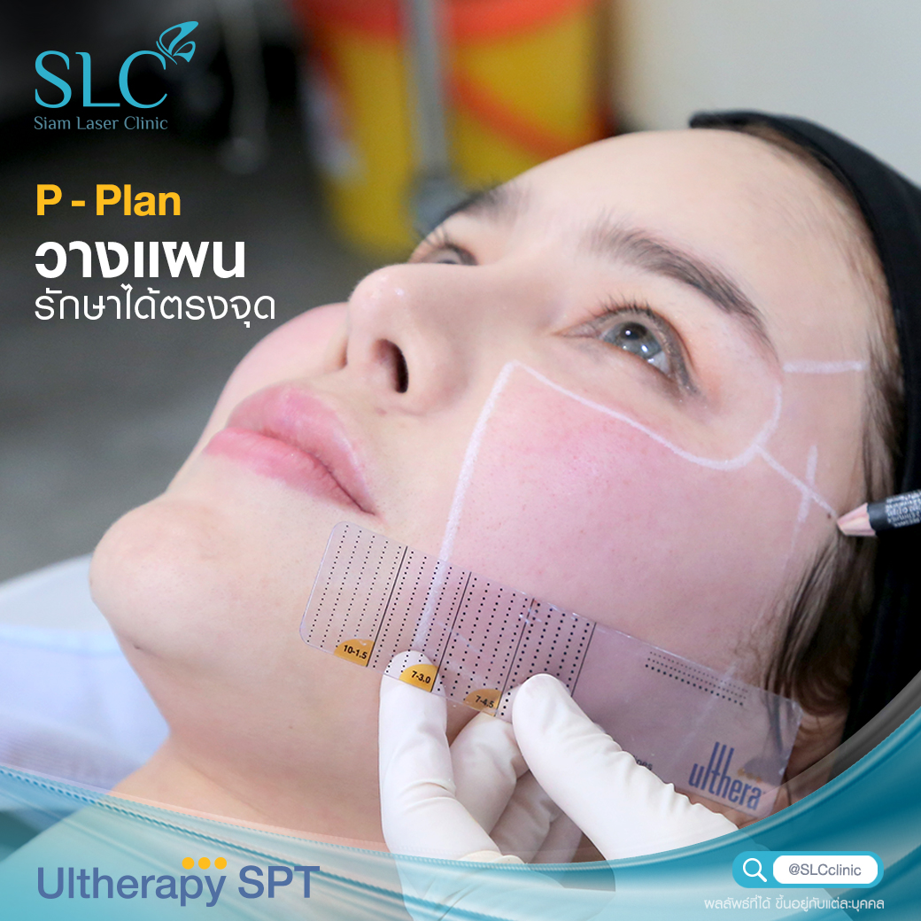 Ultherapy SPT ยกกระชับ