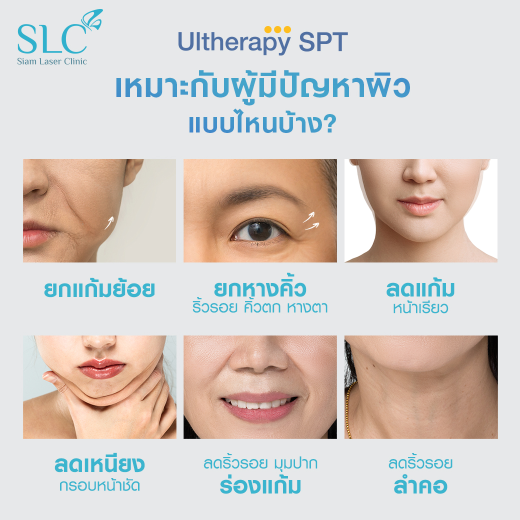 Ultherapy SPT ยกกระชับ