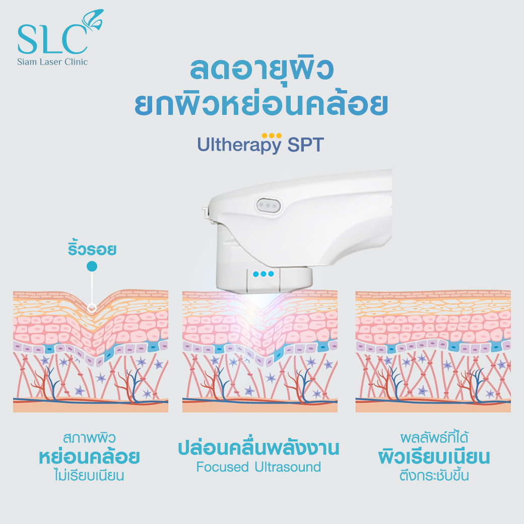 Ultherapy SPT ยกกระชับ