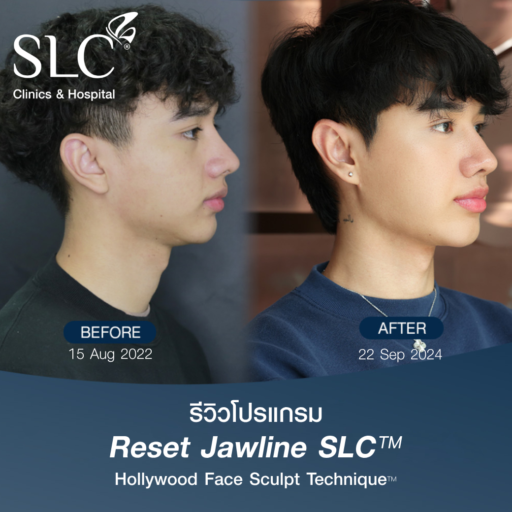รีวิวเรเดียส พลัส เรเดียสพลัสดีไหม มั้นแฟนฟลุ๊ค กะล่อน ฉีดกรอบหน้าที่ไหน