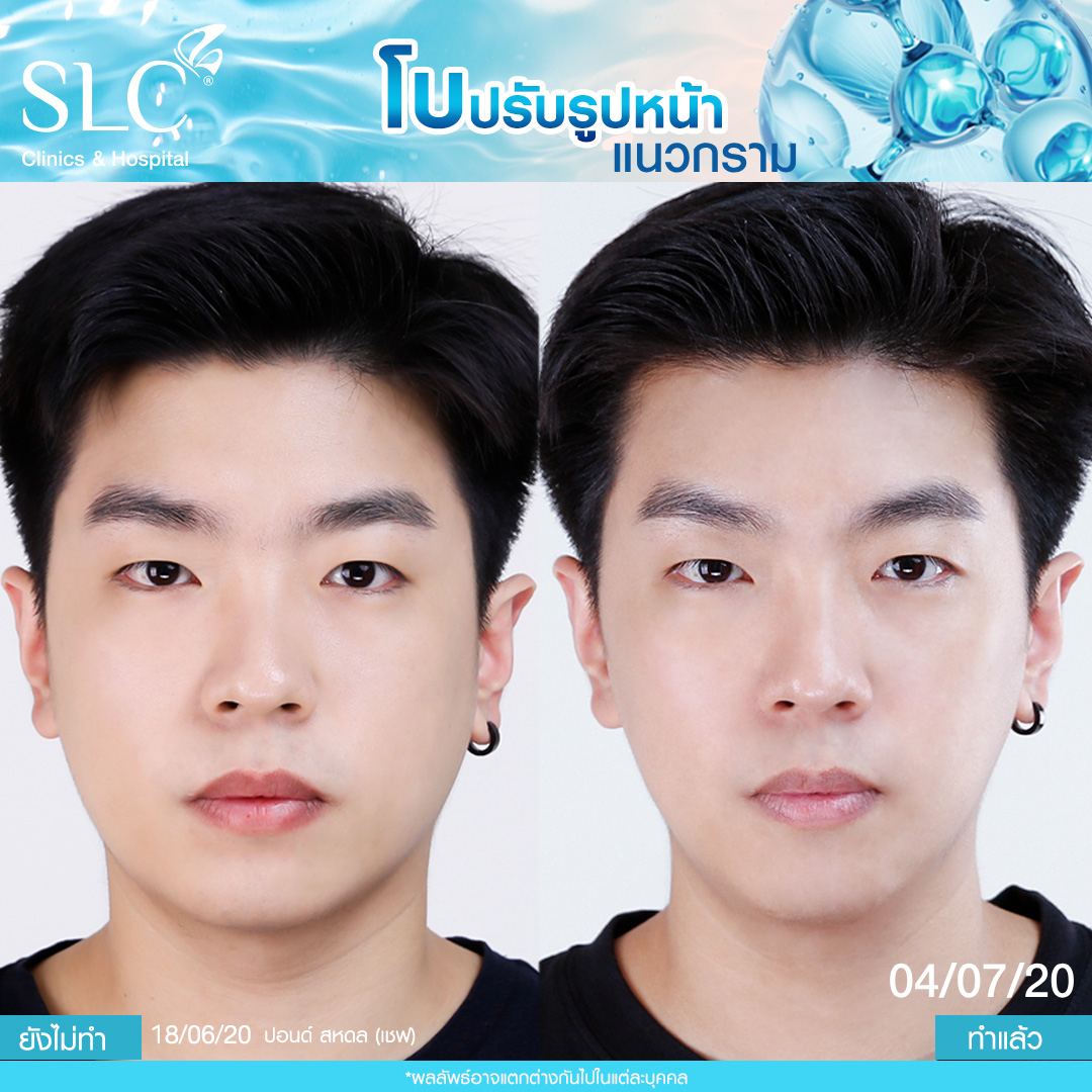 รีวิวโบท็อกซ์ ฉีดโบที่ไหนดี