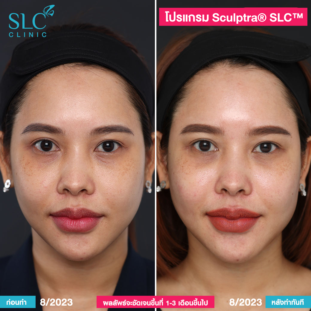 เติมร่องแก้ม , กระชับหน้า , Sculptra คืออะไร , ฉีดผิว , แก้หน้าเหี่ยว , ฉีดฟิลเลอร์ยกหน้า , ไหมน้ำ