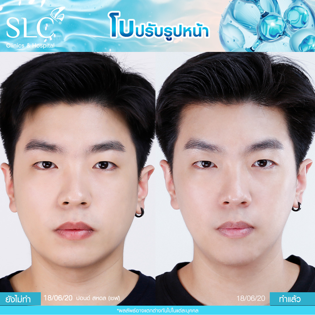รีวิวโบท็อกซ์ ฉีดโบที่ไหนดี