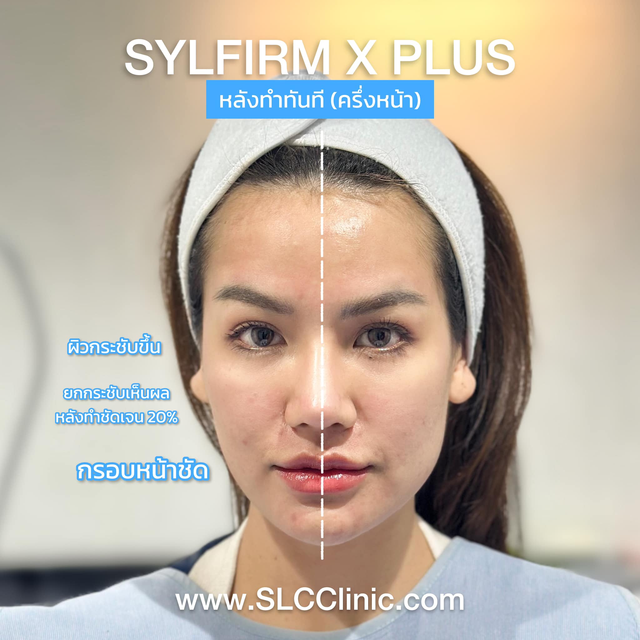 Sylfirm X Plus, Sylfirm, ยกกระชับหน้า, กระชับรูขุมขน, งานผิว, รักษาฝ้า, รักษาหลุมสิว