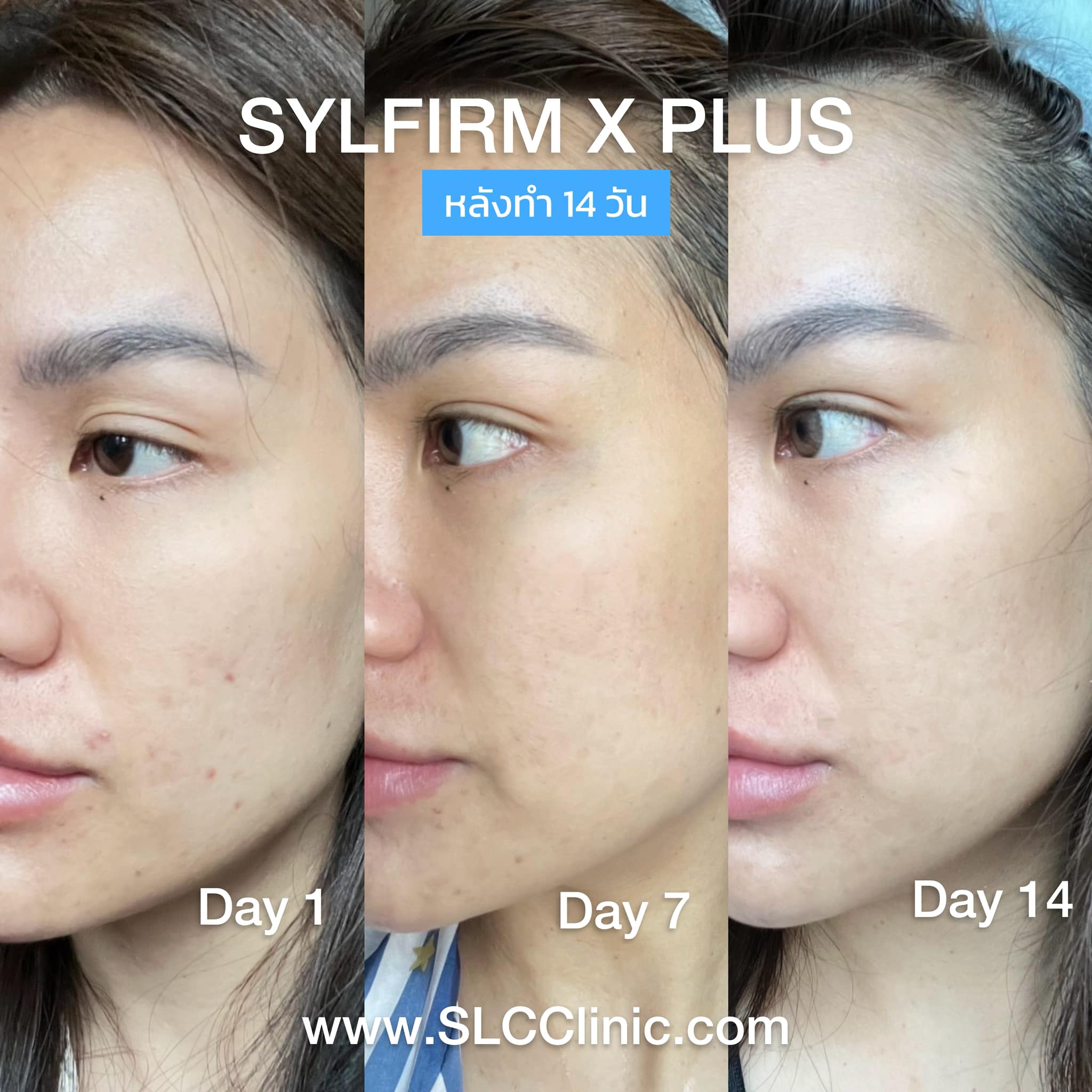 Sylfirm X Plus, Sylfirm, ยกกระชับหน้า, กระชับรูขุมขน, งานผิว, รักษาฝ้า, รักษาหลุมสิว