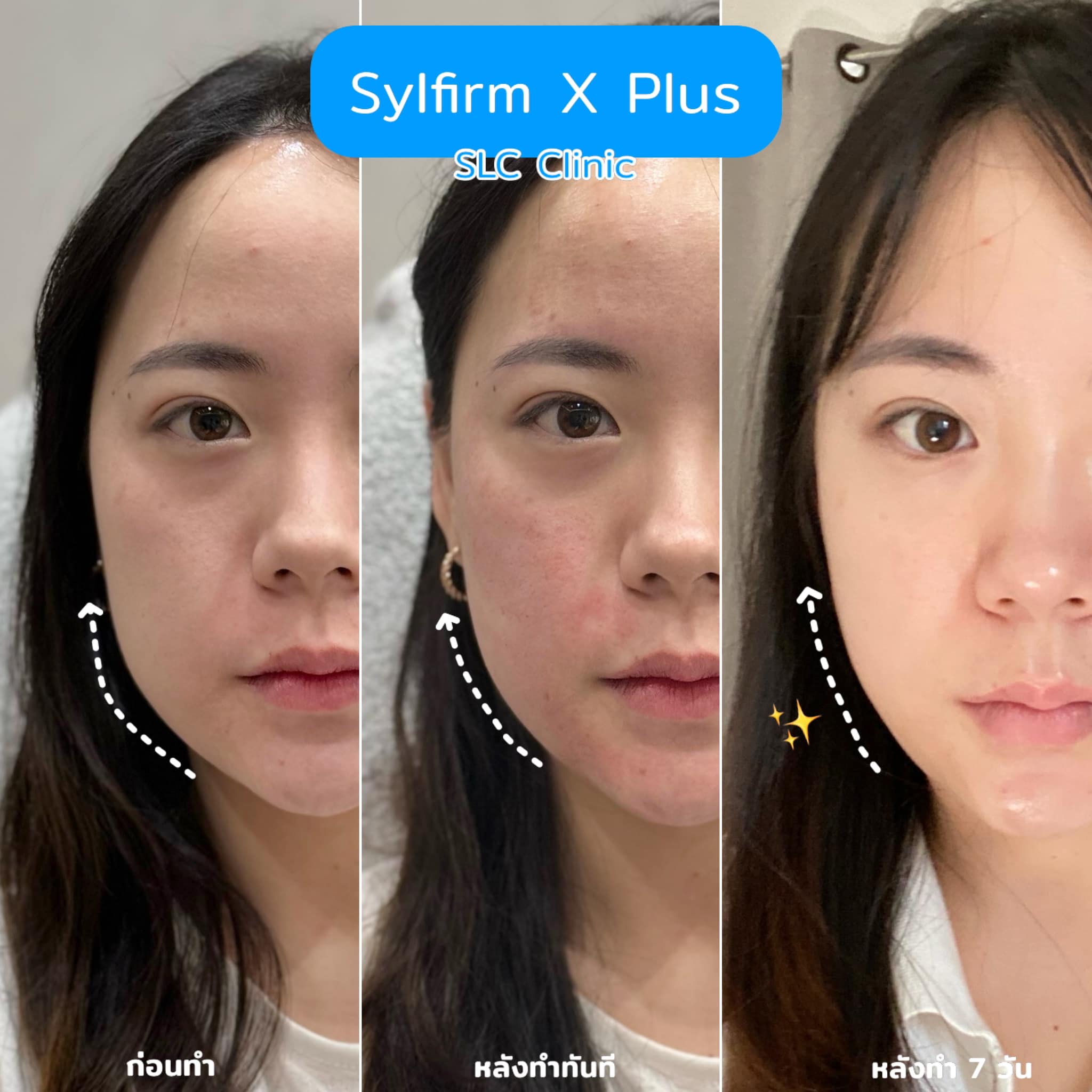 Sylfirm X Plus, Sylfirm, ยกกระชับหน้า, กระชับรูขุมขน, งานผิว, รักษาฝ้า, รักษาหลุมสิว